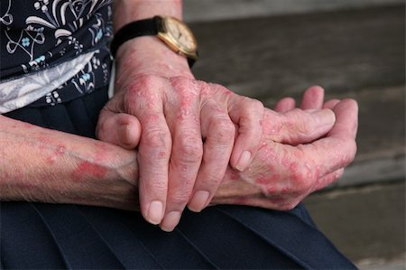 rashes on elderly people - Extreme sceriosis skin disease on the hands of an elderly female. Stock Photo - Budget Royalty-Free & Subscription, Code: 400-04468760