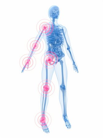 simsearch:400-04163427,k - 3d rendered anatomy illustrationof a human skeleton with painful joints Stockbilder - Microstock & Abonnement, Bildnummer: 400-04486962