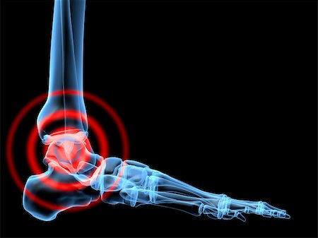 3d rendered x-ray illustration of a painful human foot Stock Photo - Budget Royalty-Free & Subscription, Code: 400-04482962