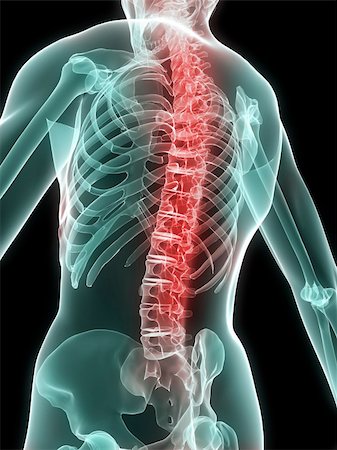 simsearch:400-04008303,k - 3d rendered anatomy illustration of a human skeleton with a painful spine Stockbilder - Microstock & Abonnement, Bildnummer: 400-04499854