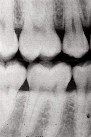 electromagnetism - A dental x-ray Photographie de stock - Aubaine LD & Abonnement, Code: 400-04506333