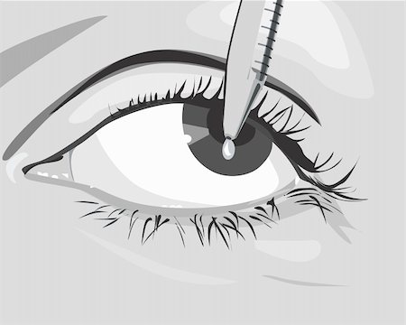 eye drops with eye dropper - Illustration of applying medical drops to eye Stock Photo - Budget Royalty-Free & Subscription, Code: 400-04513466