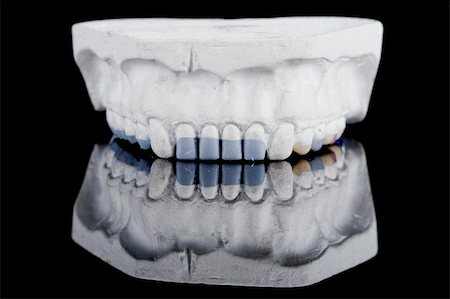 gypsum model of a human teeth on black background Foto de stock - Royalty-Free Super Valor e Assinatura, Número: 400-04577386