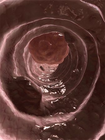 3d rendered illustration of a colon with polyps and carzinoma Photographie de stock - Aubaine LD & Abonnement, Code: 400-04602162