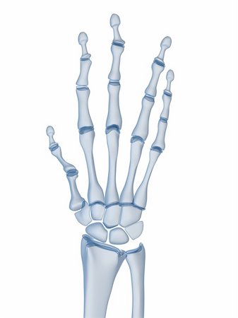rheumatoid arthritis - 3d rendered x-ray illustration of a skeletal hand with arthritis Stock Photo - Budget Royalty-Free & Subscription, Code: 400-04660215