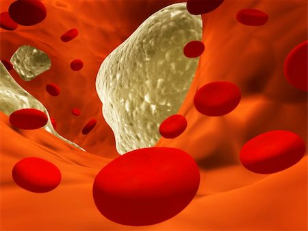 Atherosclerosis - clogged artery and erythrocytes Stockbilder - Microstock & Abonnement, Bildnummer: 400-04780695