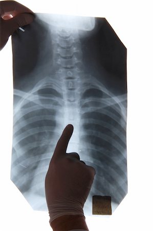 pneumoniae - Doctor analyzes x-ray image Stock Photo - Budget Royalty-Free & Subscription, Code: 400-04801740