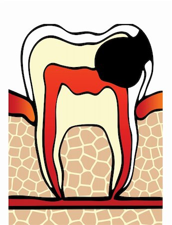 symptoms dental cavity vector illustration Stockbilder - Microstock & Abonnement, Bildnummer: 400-04821582