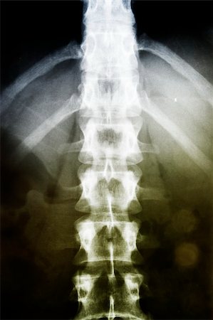 X-ray of the spinal column. Photographie de stock - Aubaine LD & Abonnement, Code: 400-04822457