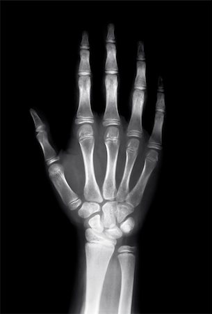 X ray image of human hand Stock Photo - Budget Royalty-Free & Subscription, Code: 400-04823440