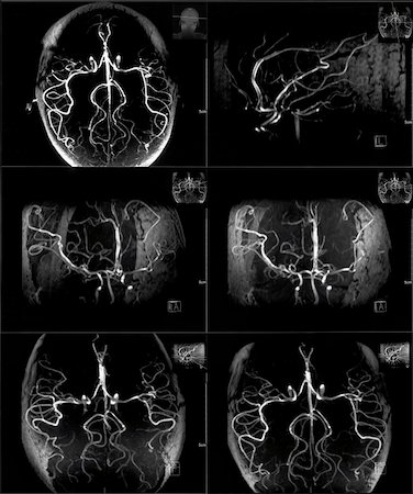 Mri scan of veins in human head Stock Photo - Budget Royalty-Free & Subscription, Code: 400-04823788