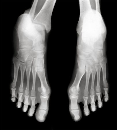 structure of a leg - Foot fingers exposed on x-ray black and white film Stock Photo - Budget Royalty-Free & Subscription, Code: 400-04823790