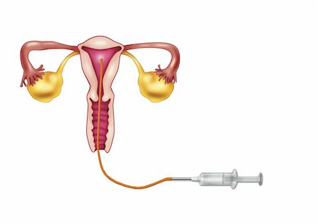 diagram illustration of artificial insemination process Photographie de stock - Aubaine LD & Abonnement, Code: 400-04850157