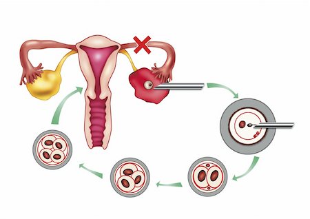 diagram illustration of artificial insemination process Foto de stock - Super Valor sin royalties y Suscripción, Código: 400-04850158