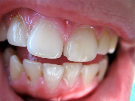 demidov (artist) - bad teeth Stock Photo - Budget Royalty-Free & Subscription, Code: 400-04940616
