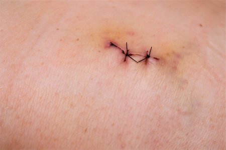 scars - The stitches in the skin of a patient. Stock Photo - Budget Royalty-Free & Subscription, Code: 400-04989504