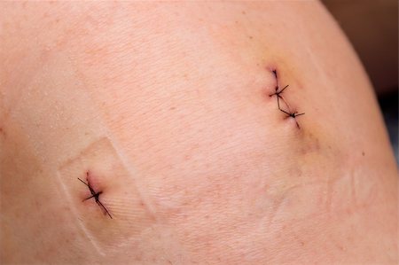 scars - The stitches in the skin of a patient. Stock Photo - Budget Royalty-Free & Subscription, Code: 400-04989503