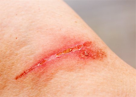 A burn scar that is partly healed Stockbilder - Microstock & Abonnement, Bildnummer: 400-04991030