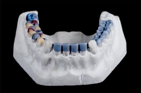 gypsum model of a human teeth on black background Stockbilder - Microstock & Abonnement, Bildnummer: 400-05097309