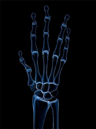 rheumatoid arthritis - 3d rendered x-ray illustration of a skeletal hand with arthritis Stock Photo - Budget Royalty-Free & Subscription, Code: 400-05186091