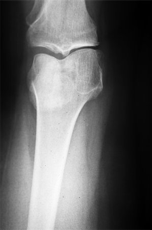 Medical x-ray of a damaged knee in vertical format Stock Photo - Budget Royalty-Free & Subscription, Code: 400-05186180