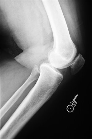 fraktur - Side xray view of an injured knee Stockbilder - Microstock & Abonnement, Bildnummer: 400-05186181