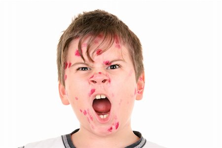 Boy is ill with  chicken pox on  white background Stock Photo - Budget Royalty-Free & Subscription, Code: 400-05298242