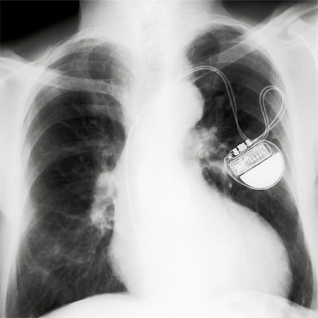 Chest with the pace maker on x-rays Stock Photo - Budget Royalty-Free & Subscription, Code: 400-05312937