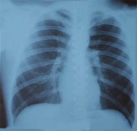 X-ray picture of lungs Stock Photo - Budget Royalty-Free & Subscription, Code: 400-05335540