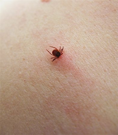 sucking tick, ixodes ricinus, sucking on a human Stock Photo - Budget Royalty-Free & Subscription, Code: 400-05333727