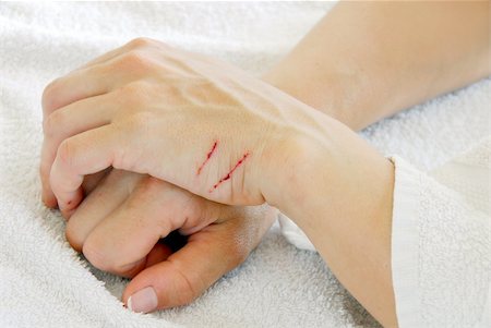 two scratch on female crossed arms closeup Stockbilder - Microstock & Abonnement, Bildnummer: 400-05353311