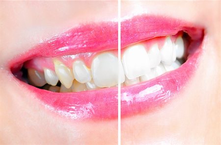 simsearch:400-04287911,k - Before and after of a dental whitening procedure Photographie de stock - Aubaine LD & Abonnement, Code: 400-05370434