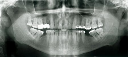 Front Xray image of human mouth with dental fillings Stock Photo - Budget Royalty-Free & Subscription, Code: 400-05671321