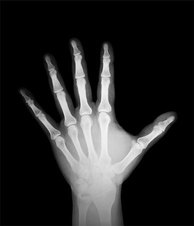 pictures of broken bones in xray - x-ray of human hand Stock Photo - Budget Royalty-Free & Subscription, Code: 400-05889176