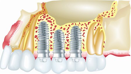 straighten - Dental implants Stock Photo - Budget Royalty-Free & Subscription, Code: 400-06076002