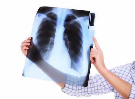 pneumonia - A picture of lungs x-ray over white background Stock Photo - Budget Royalty-Free & Subscription, Code: 400-06135606