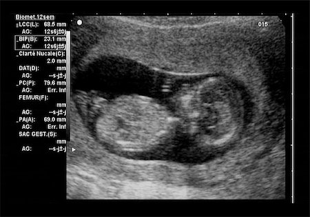 pregnant scan - ultrasound fetus at 12 weeks Foto de stock - Super Valor sin royalties y Suscripción, Código: 400-06567244