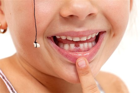 Child pointing to missing teeth, pulled out with a string - closeup on mouth Stock Photo - Budget Royalty-Free & Subscription, Code: 400-06642085