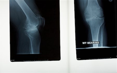 A x-ray of a knee joint needing a knee replacement operation Foto de stock - Super Valor sin royalties y Suscripción, Código: 400-06695295