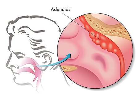 sistema inmune - medical illustration of the adenoids Foto de stock - Super Valor sin royalties y Suscripción, Código: 400-06737358