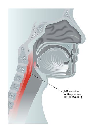 medical illustration of the effects of pharyngitis Foto de stock - Super Valor sin royalties y Suscripción, Código: 400-06737638