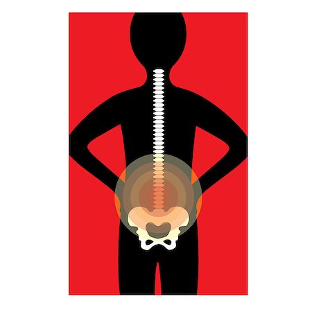 Silhouette of a human back with the spine - rays of pain are shown on the lower back Stock Photo - Budget Royalty-Free & Subscription, Code: 400-06852984
