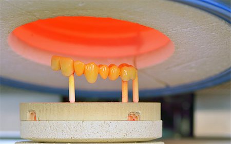 ceramic-metal compound crowns in furnace, dental technology Stock Photo - Budget Royalty-Free & Subscription, Code: 400-06952434