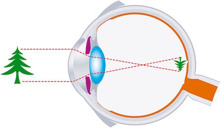 Rays of light are bundled by the lens in the human eye and are inverse focused on the retina. Illustration. Photographie de stock - Aubaine LD & Abonnement, Code: 400-07034997