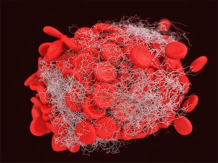 simsearch:400-04189840,k - 3d illustration of a blood clot, thrombus or embolus with coagulated red and white blood cells, platelets and clotting factors trapped in an insoluble fibrin network in the blood vessels of the body Foto de stock - Super Valor sin royalties y Suscripción, Código: 400-07169861