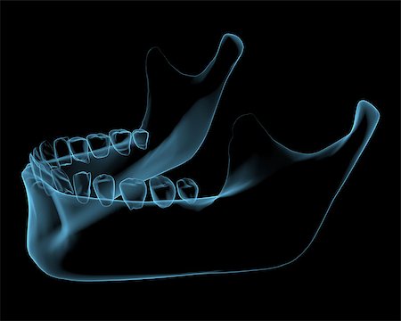 Human jaw x-ray blue transparent isolated on black Stock Photo - Budget Royalty-Free & Subscription, Code: 400-07516209