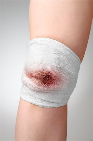 simsearch:400-07669067,k - Injured knee with bloody gauze bandage Fotografie stock - Microstock e Abbonamento, Codice: 400-07817450