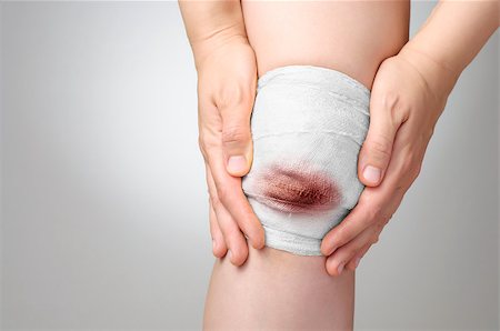 simsearch:400-07669067,k - Injured painful knee with bloody gauze bandage Fotografie stock - Microstock e Abbonamento, Codice: 400-07817735