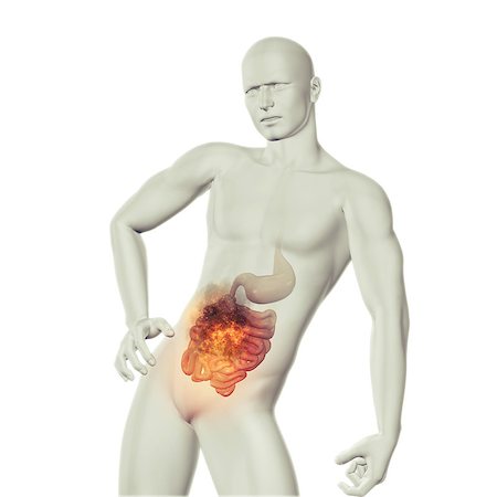 3D render of a male medical figure with fire effect in stomach with exposed guts Stock Photo - Budget Royalty-Free & Subscription, Code: 400-08223111