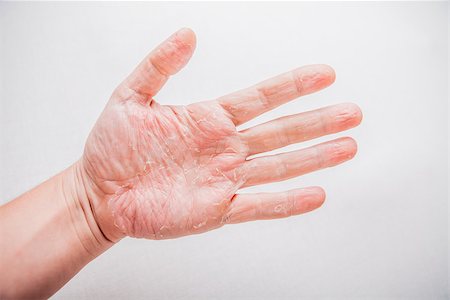 dry skin - The problem with many people - eczema on hand. Isolated background. Stock Photo - Budget Royalty-Free & Subscription, Code: 400-08313973